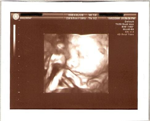 ultrasound angel photo